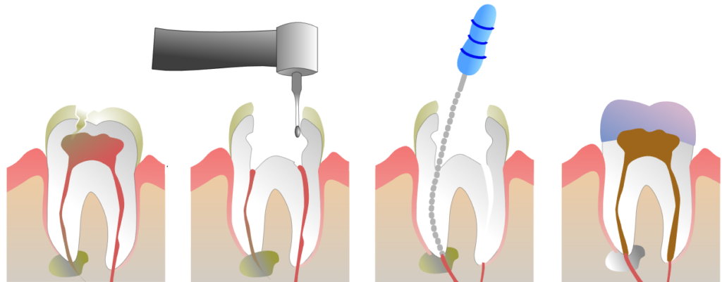 root-canal-1024x401[1]